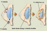 ThS.BS Nguyễn Tấn Bảo Ân chia sẻ về những biến chứng có thể gặp sau nâng ngực – Cách phòng ngừa và xử lý sớm