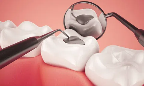 Trám răng thẩm mỹ: Chi phí, lưu ý & địa chỉ hàn răng uy tín