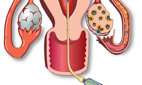Bơm IUI và điều bạn cần biết