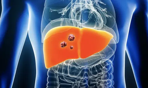 Ung thư gan có thể được kiểm soát nhờ những phương pháp không ngờ tới