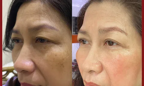 Trị nám tại TP.HCM, nơi nào uy tín?