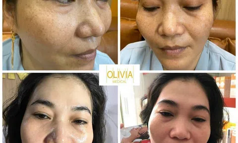 Thẩm mỹ viện trị nám uy tín tại Gia Lai