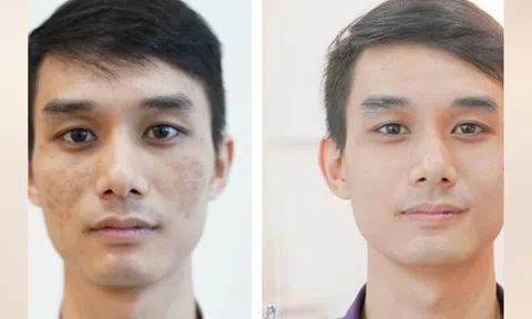 Liệu trình trị nám, tàn nhan hiệu quả dành cho nam tại Spa Men&Man