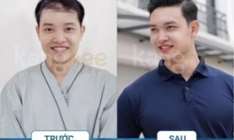 Trị rụng tóc, hói đầu không cần phẫu thuật với công nghệ Nano Cell Hairline hàng đầu Hoa Kỳ