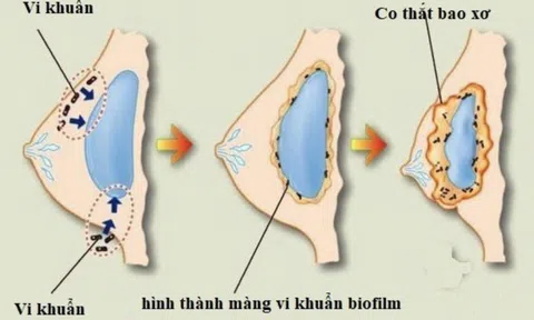 ThS.BS Nguyễn Tấn Bảo Ân chia sẻ về những biến chứng có thể gặp sau nâng ngực – Cách phòng ngừa và xử lý sớm