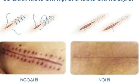 Nghiên cứu so sánh hiệu quả của các kỹ thuật khâu và chăm sóc vết thương trong việc đạt được 'sẹo tàng hình' sau phẫu thuật
