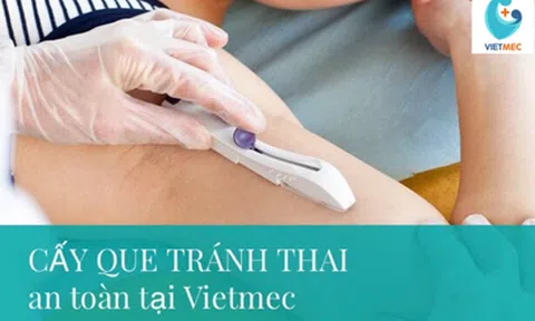 3 vấn đề chị em thường quan tâm về cấy que tránh thai
