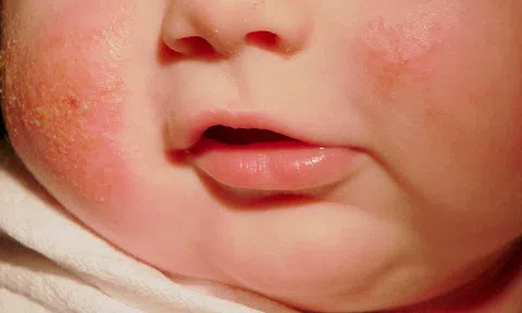 7 mẹo giảm triệu chứng ngứa do bệnh chàm từ thiên nhiên
