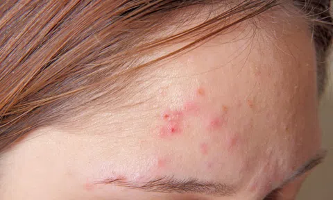 MỤN TRỨNG CÁ – NỖI ÁM ẢNH VÌ LÀN DA XẤU XÍ