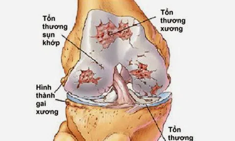 Thoái hóa khớp gối: Nguyên nhân và biện pháp khắc phục hiệu quả, an toàn