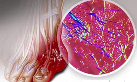 Nguyên nhân gây bệnh gout và giải pháp hữu hiệu từ sản phẩm Hoàng Thống Phong