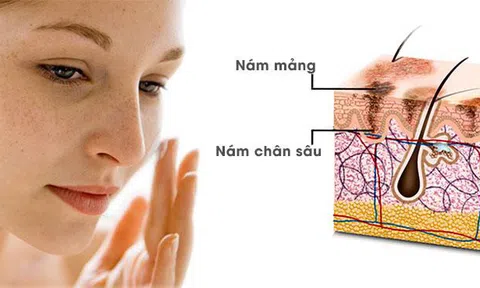 DỊCH VỤ TRỊ NÁM LASER PICOSURE Tại TMV Quốc Tế Bắc Âu