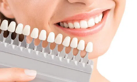 Răng sứ thẩm mỹ - xu hướng làm đẹp mới của phụ nữ