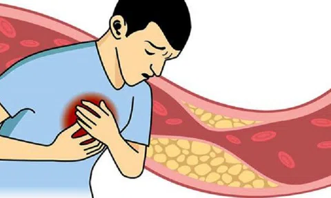 Kyoman – viên uống thảo dược hạ mỡ máu, ngừa nguy cơ bệnh  tim mạch