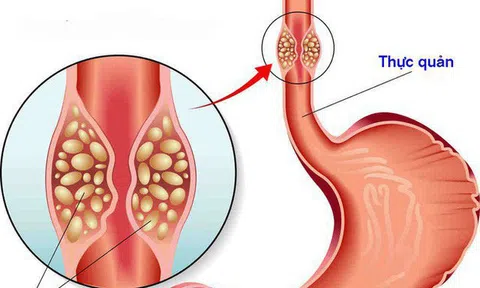 Trung Quốc phát triển mô hình chẩn đoán ung thư thực quản có độ chính xác cao