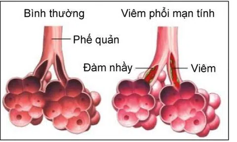 Bộ Y tế khuyến cáo về phòng chống viêm phổi cấp do chủng vi rút mới tại Trung Quốc
