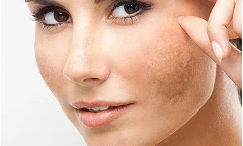 Giải mã bí mật của viên uống mờ nám đang được chị em…