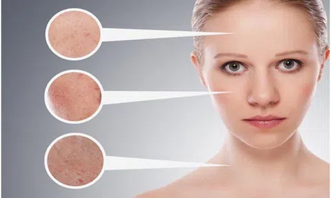 Giải mã những điều chị em chưa biết về nám, sạm da