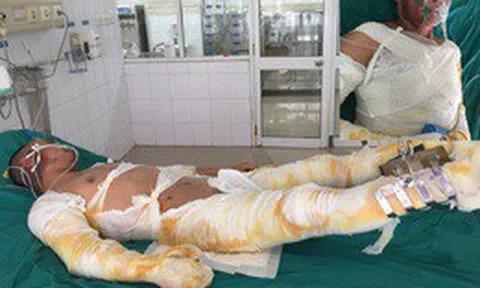 Ba người trong gia đình bị lửa thiêu nguy kịch cầu mong nhà hảo tâm giúp đỡ