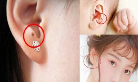 Nốt ruồi ở vị trí này quý như kim cương, có được là lộc
