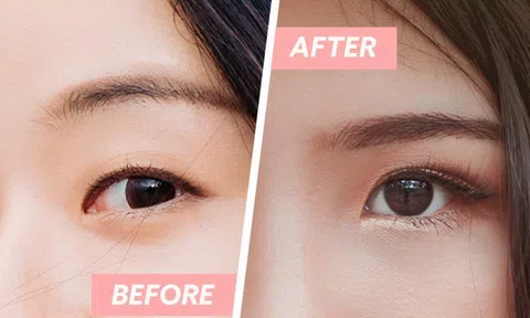 Sở hữu đôi mắt xinh đẹp với phẫu thuật tạo hình mắt hai mí