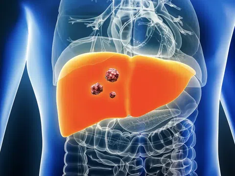 Ung thư gan có thể được kiểm soát nhờ những phương pháp không ngờ tới