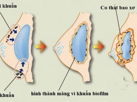 ThS.BS Nguyễn Tấn Bảo Ân chia sẻ về những biến chứng có thể gặp sau nâng ngực – Cách phòng ngừa và xử lý sớm