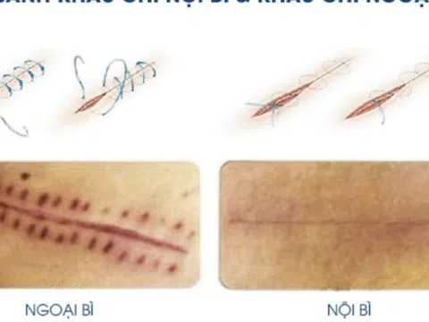 Nghiên cứu so sánh hiệu quả của các kỹ thuật khâu và chăm sóc vết thương trong việc đạt được 'sẹo tàng hình' sau phẫu thuật